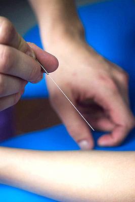 Doctor hand acupuncture needle patient arm-stock-photo